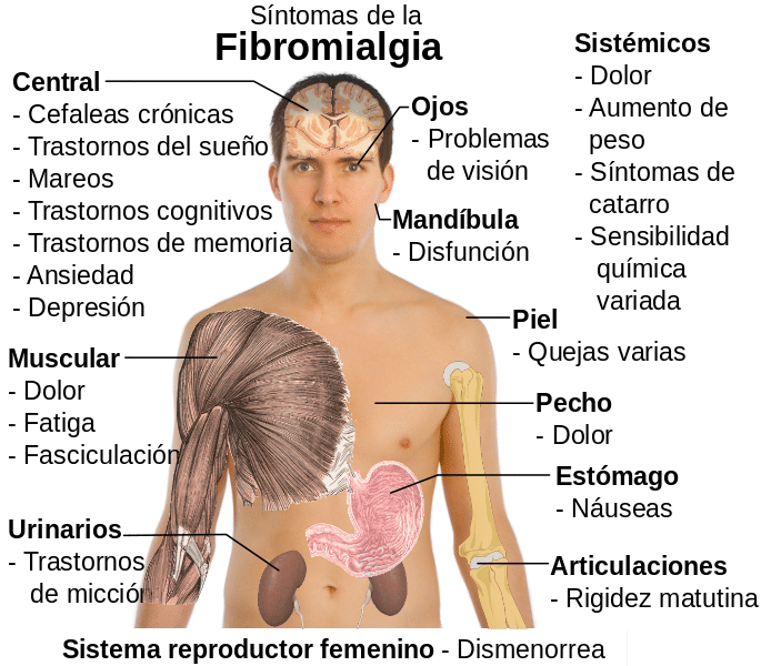 síntomas de la fibromialgia