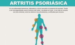 artritis psoriásica