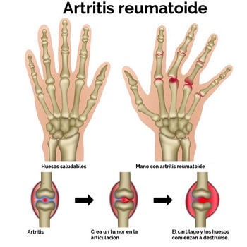 artritis reumatoide