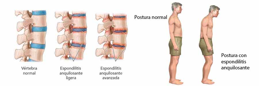 avance espondilistis anquilosante