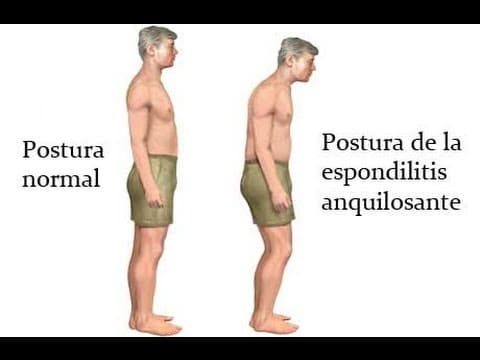 postura normal y con espondilistis anquilosante