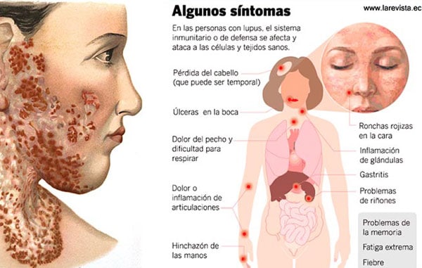 sintomas del lupus